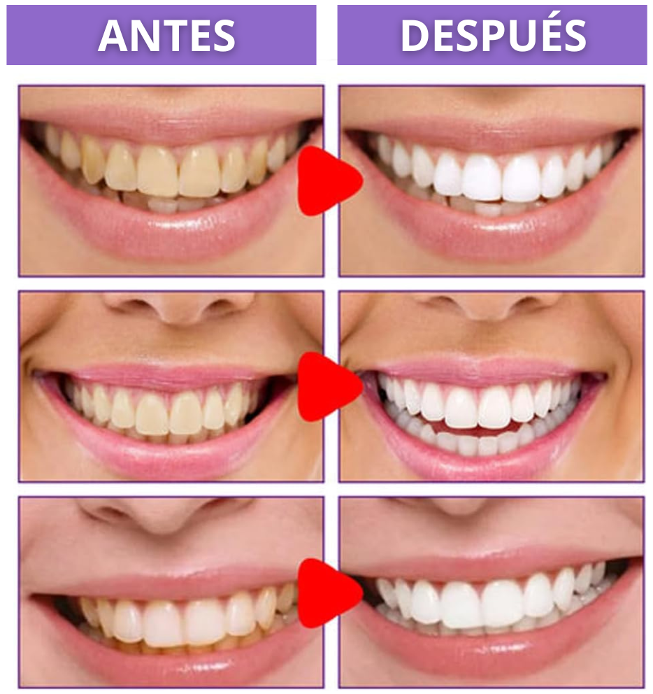 Blanqueador Dental V34 Promoción 1 + 1 Limitada